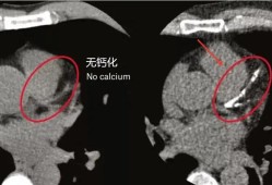 胎儿钙化是什么意思（胎儿钙化是什么意思?）
