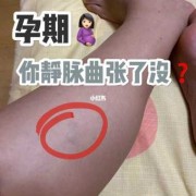 怀孕腿部静脉曲张怎么治疗,孕期静脉曲张如何缓解