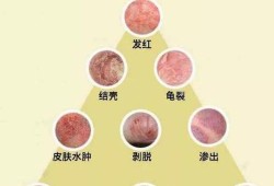 孕妇长湿疹会影响胎儿吗（孕妇长湿疹会影响胎儿吗知乎）