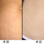 孕期长妊娠纹怎么办（孕期长妊娠纹怎么办啊）