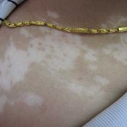 白癜风具有遗传性吗,自癜风能在孕期自愈吗女性