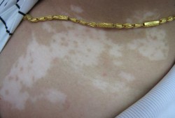 白癜风具有遗传性吗,自癜风能在孕期自愈吗女性