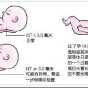 nt增厚胎儿正常的概率（nt增厚羊穿容易过吗）
