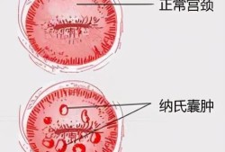 怀孕了子宫里面有囊肿如何是好,孕期囊肿是什么原因引起的