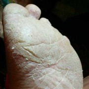 孕妇脚底脱皮是怎么回事呢,孕期皮肤干燥起皮屑怎么办