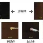 怀孕初期的白带是什么样子,早孕期间白色分泌物