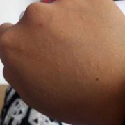 孕期长肉疙瘩（怀孕36周，手背胳膊腿上发痒一挠就起小疙瘩，怎么回事）