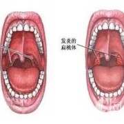 备孕期间扁桃体发炎（备孕期间扁桃体发炎怎么办最简单的方法）