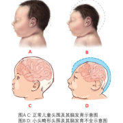 胎儿小脑畸形（胎儿小脑畸形）