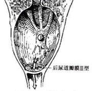 胎儿后尿道瓣膜（胎儿后尿道瓣膜）