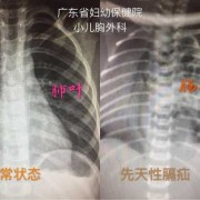 胎儿膈疝是遗传的吗（胎儿膈疝是遗传的吗）