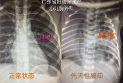 胎儿膈疝是遗传的吗（胎儿膈疝是遗传的吗）