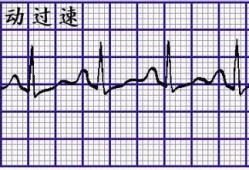 孕期窦性心律（什么是窦性心律?s-t段异常时怎么回事5）