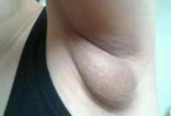 怀孕腋下长了个小肉粒怎么回事,孕期腋下长小疙瘩会痒