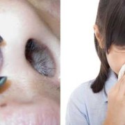 孕期有过敏性鼻炎,鼻炎影响胎儿发育吗