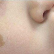 婴儿脸上有胎记是怎么回事,怎样预防胎儿胎记的发生