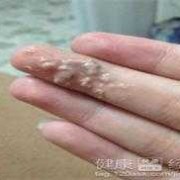怀孕期间白带发黄图片