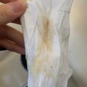 孕期总是出血（孕期流血有哪些原因）