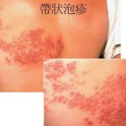 孕妇起疱疹影响胎儿吗（孕妇起疱疹影响胎儿吗图片）