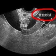 盆腔积液怀孕了对胎儿有影响吗（盆腔积液怀孕了对胎儿有影响吗）