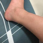 孕期脚肿是男孩还是女孩（孕期脚肿是男孩还是女孩论坛）