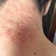 孕期脖子痒（孕期脖子痒怎么办）