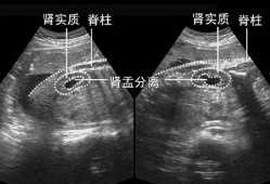 胎儿双肾盂未见明显分离怎么回事,胎儿肾盂无分离是什么意思是男孩女孩呢