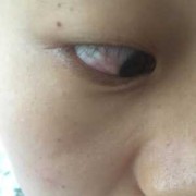 孕妇结膜炎影响胎儿吗（孕妇结膜炎影响胎儿吗视频）
