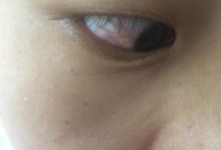 孕妇结膜炎影响胎儿吗（孕妇结膜炎影响胎儿吗视频）