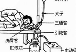 胎儿洗胃（胎儿洗胃怎么洗）