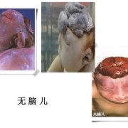 胎儿无脑（胎儿无脑儿是什么原因造成的）
