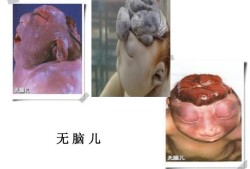 胎儿无脑（胎儿无脑儿是什么原因造成的）