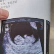 怀孕10周胎儿彩超图片（怀孕10周胎儿彩超图片）