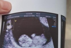 怀孕10周胎儿彩超图片（怀孕10周胎儿彩超图片）