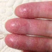 手指脱皮的原因及治疗方法,孕期手指掉皮脱皮是怎么回事