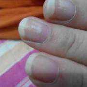 孕期指甲发白图（手指甲发白，没血色，是怎么回事）