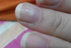 孕期指甲发白图（手指甲发白，没血色，是怎么回事）