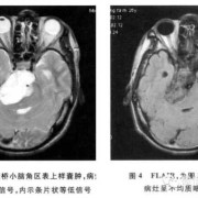 胎儿脑部囊肿能不能要（脑部囊肿严重吗）