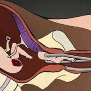 引产胎儿染色体检查（引产胎儿染色体检查必要吗）