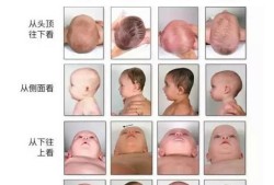 胎儿长头型正常吗（宝宝额头正常形状）
