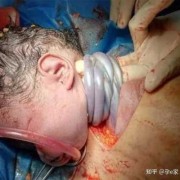 请问下大家宝宝脐带绕颈一周，有什么危险吗,胎儿脐带绕颈二圈会有危险吗