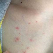 胸口上出现小红疙瘩,孕期胸口长痘痘怎么回事