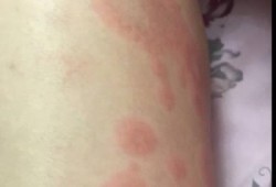 孕期大腿痒是怎么回事（孕期大腿痒是怎么回事儿）