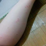 孕期腿痒是怎么回事啊（孕期下面痒什么原因）