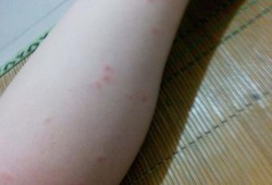 孕期腿痒是怎么回事啊（孕期下面痒什么原因）