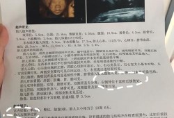 胎儿无右肾（胎儿无右肾是什么原因）