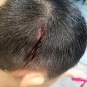 小孩头部皮下囊肿怎么治疗,胎儿头部有囊肿怎么办呢