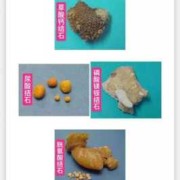有身孕得肾结石怎么办,肾结石孕期还能补钙吗