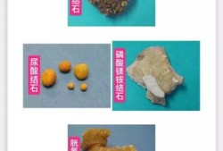 有身孕得肾结石怎么办,肾结石孕期还能补钙吗