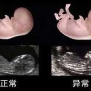 产检nf是什么,孕期nf检查是什么检查